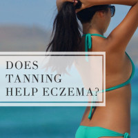 Does tanning help eczema?